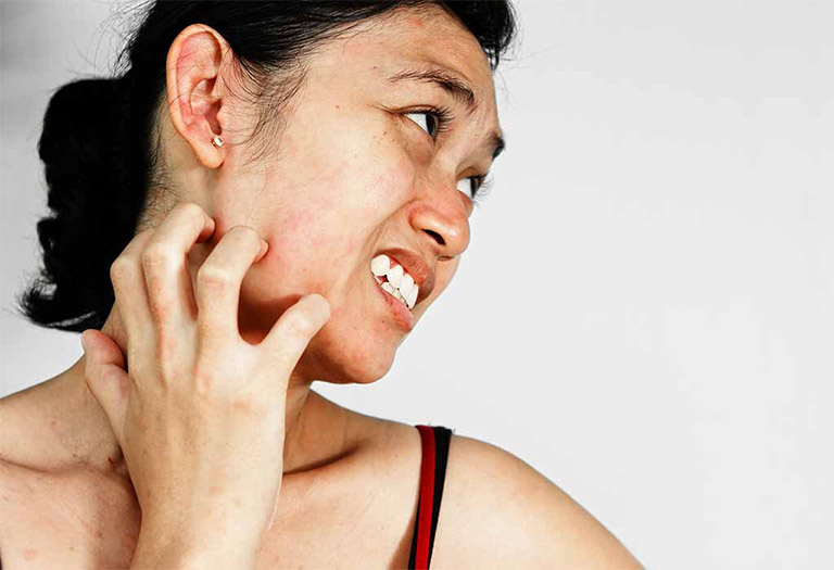 Da mặt đỏ rát và ngứa ngáy là bệnh gì? Triệu chứng này có nguy hiểm không?