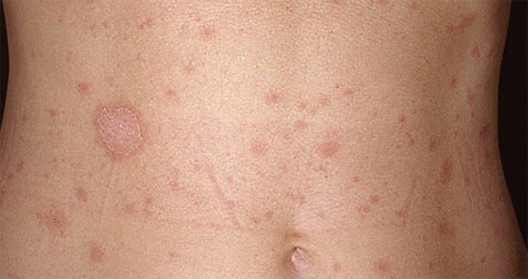 Vẩy phấn hồng là tình trạng da bị viêm nhiễm và dẫn đến tình trạng da bị sần nhưng không gây ngứa