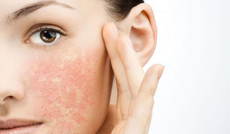 Dị ứng mỹ phẩm khiến da mặt xuất hiện mụn đỏ và gây ngứa rát