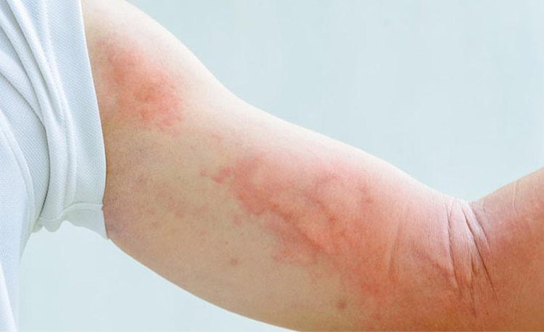 Nổi mẩn đỏ khắp người không ngứa sốt cũng có thể là triệu chứng của bệnh mề đay