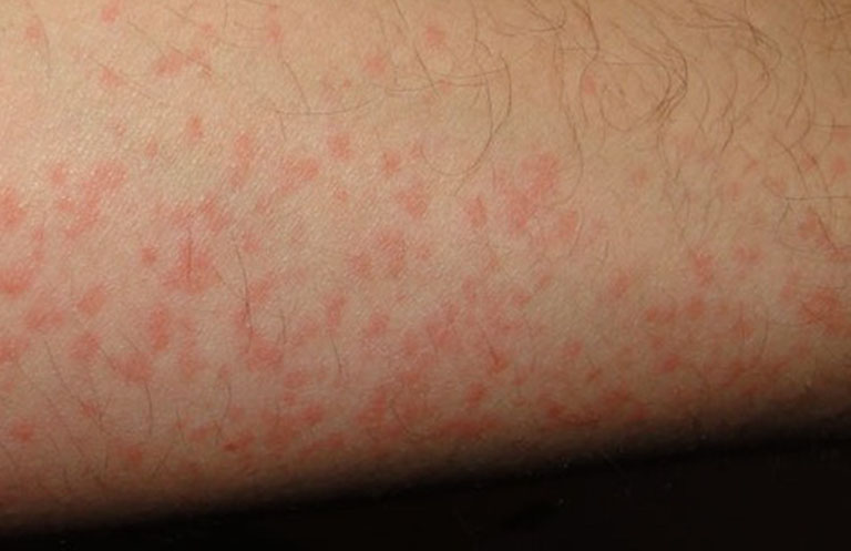 Nổi đốm đỏ trên da nhưng không ngứa có thể là triệu chứng của nhiều bệnh lý nguy hiểm