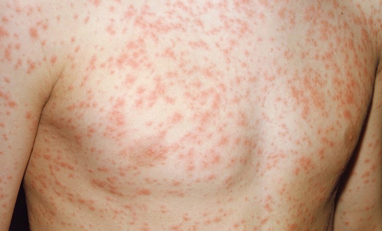 Nổi mẩn đỏ khắp người không ngứa sốt là tình trạng xảy ra khá phổ biến