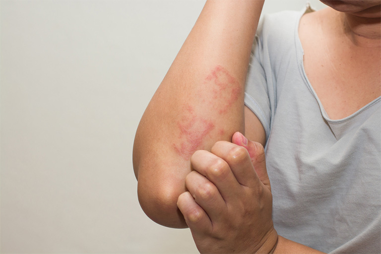 Nổi mề đay mẩn ngứa trên tay và chân có thể là biểu hiện của một số bệnh lý về da như: bệnh chàm, bệnh viêm da cơ địa, bệnh viêm da dị ứng,...