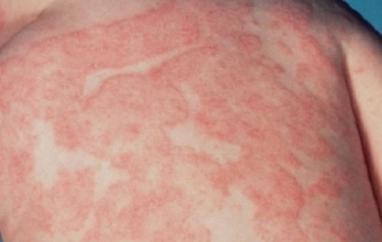 Vảy phấn hồng gây phát ban đỏ trên da có hình tròn hoặc bầu dục