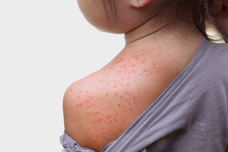 Nổi nốt đỏ trên da và kèm theo triệu chứng ngứa ngáy có thể là một dấu hiệu của một bệnh lý về da