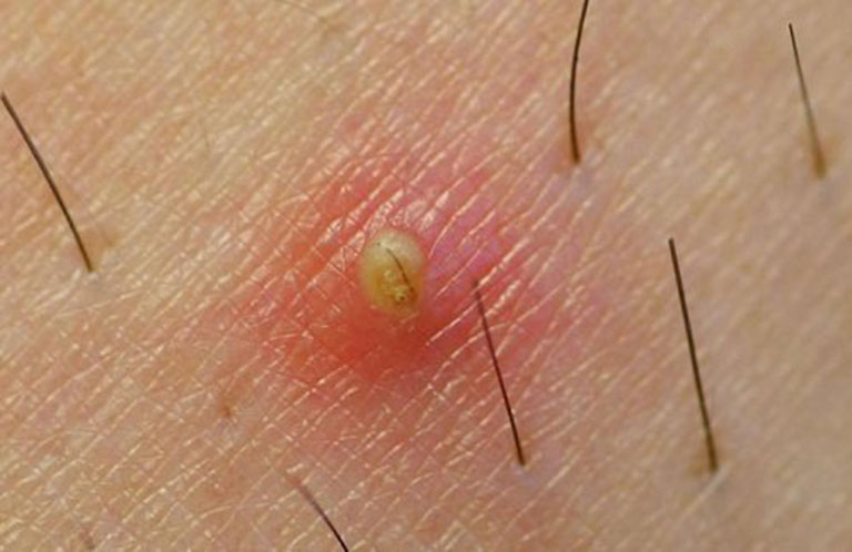 Viêm nang lông gây xuất hiện nốt mụn đỏ chứa đầy mủ trên da