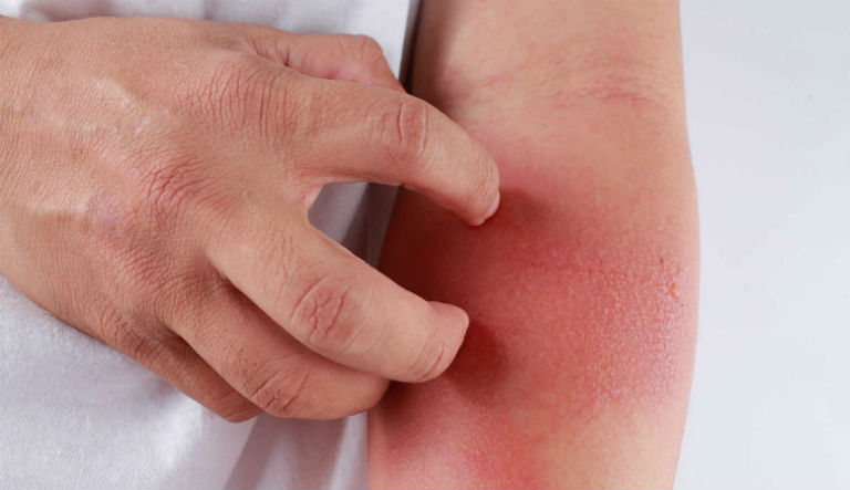 Viêm da cơ địa là tình trạng da thường xuyên bị nổi những đám mẩn ngứa khó chịu.