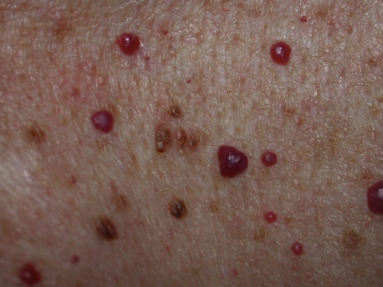 Khi bị các khối u máu sẽ xuất hiện các nốt mề đay đỏ trên da, không ngứa với kích thước khác nhau