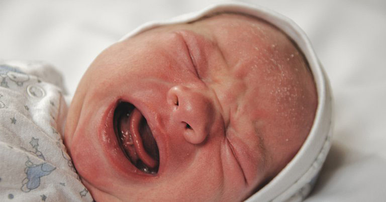 viêm da tiết bã da đầu ở trẻ sơ sinh