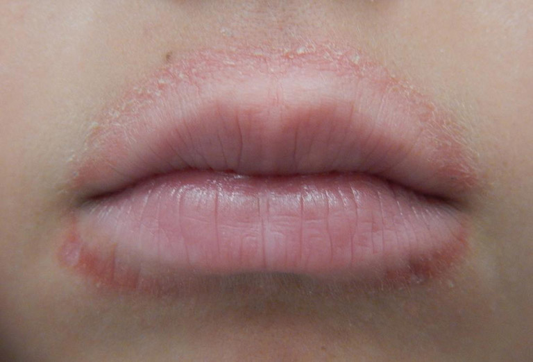 bệnh chàm môi la gi