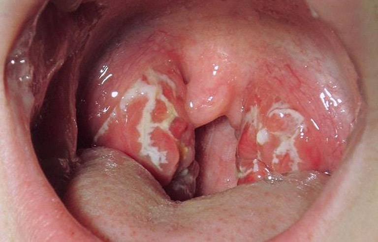 điều trị viêm họng virus