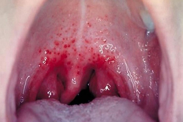 bệnh viêm họng hạt có nguy hiểm không