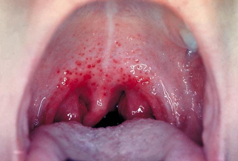 Như thế nào là họng bình thường và cách phân biệt khi bị viêm