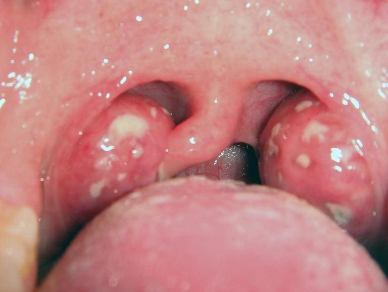 Như thế nào là họng bình thường và cách phân biệt khi bị viêm
