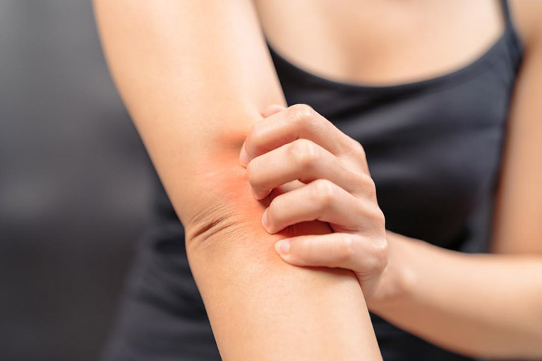 Ngứa rát, đỏ da là những biểu hiện thường gặp khi bị nhiễm trùng nấm men trên da 