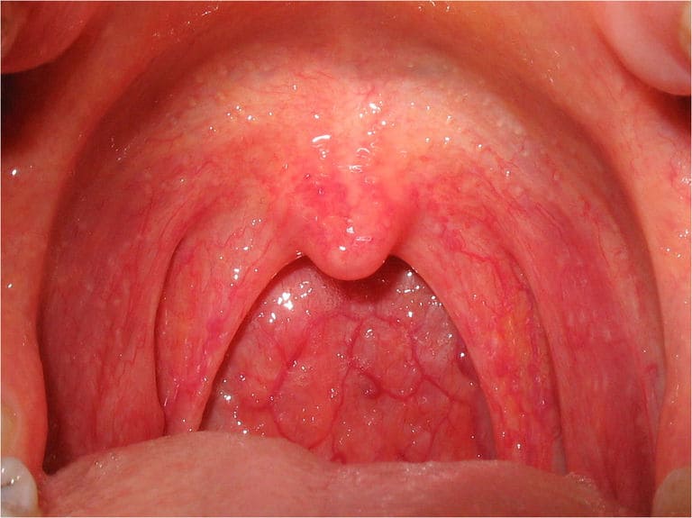 Bệnh viêm họng amidan là gì?