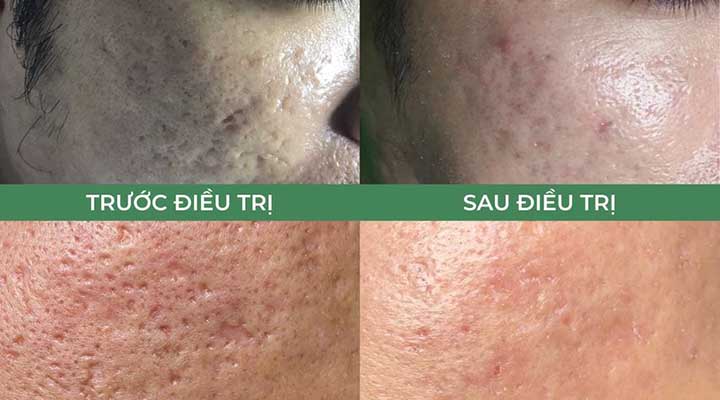 Kết quả trước và sau khi điều trị sẹo tại TPHCM doctor acnes 
