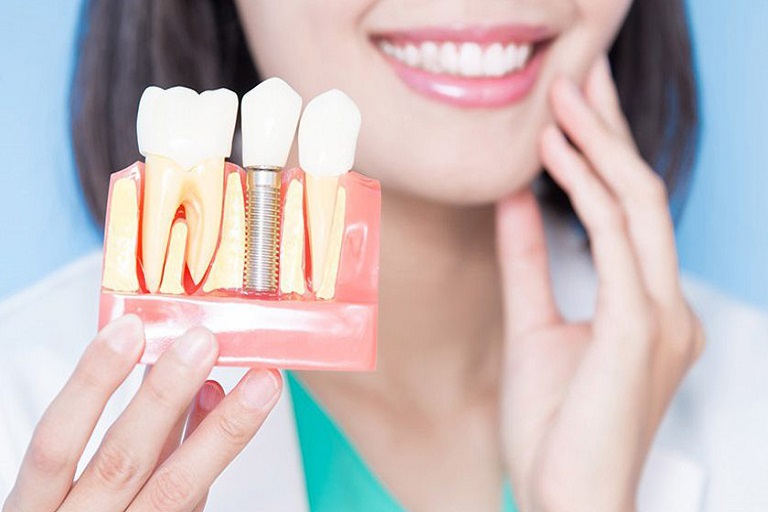 Quy trình trồng răng Implant
