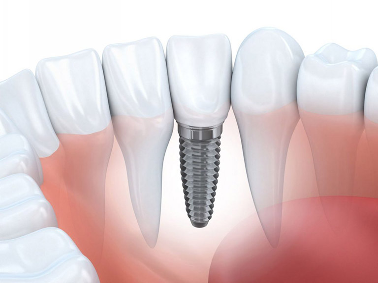 trồng răng implant hà nội, cấy ghép implant đánh giá từ Webtretho