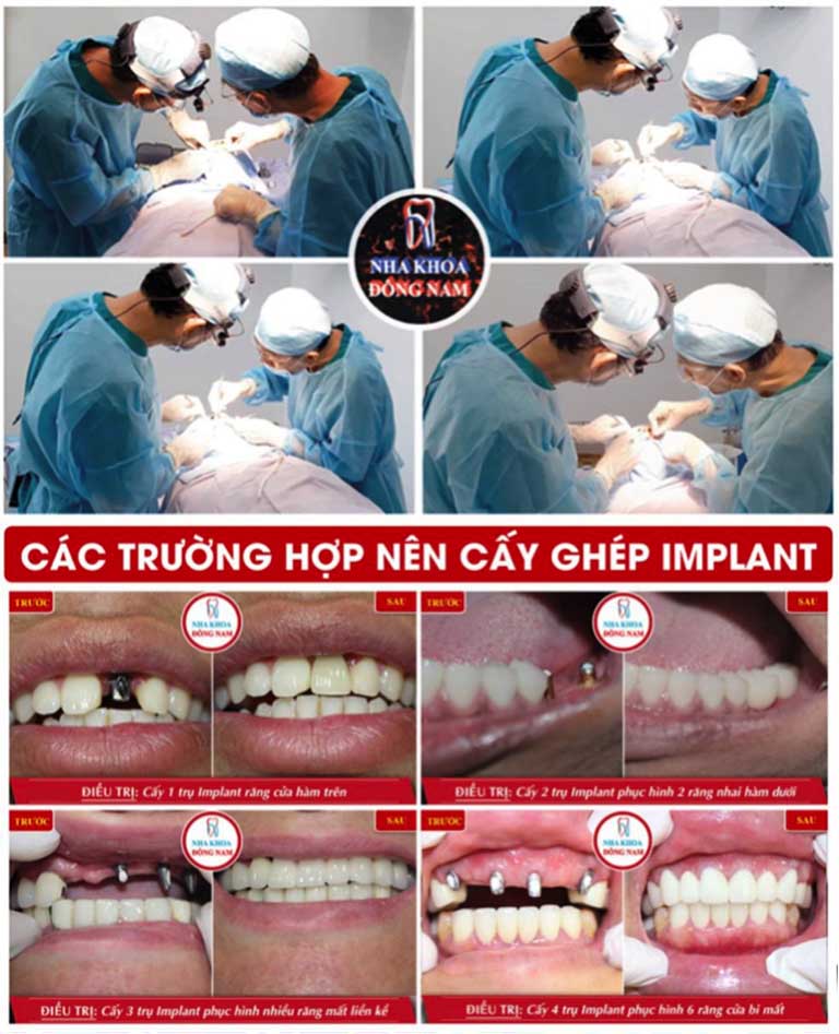 Trồng răng implant tại Nha Khoa Đông Nam 