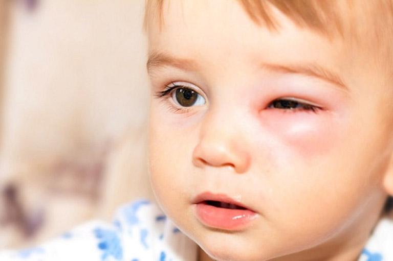 Viêm tấy ổ mắt là một biến chứng ở mắt do viêm xoang gây ra 