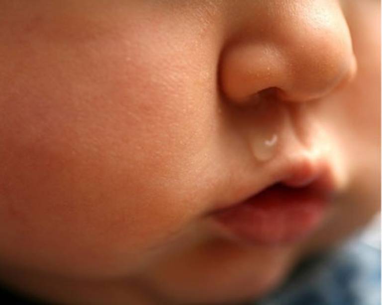 Thường xuyên chảy nước mũi là một trong những triệu chứng phổ biến của bệnh