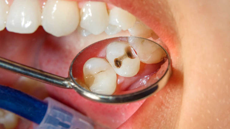 Viêm xoang hàm do sâu răng