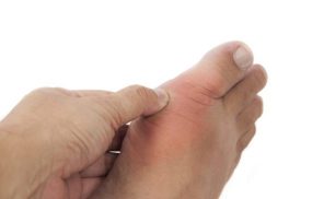 Liệu bệnh gout có lây nhiễm hay di truyền không?