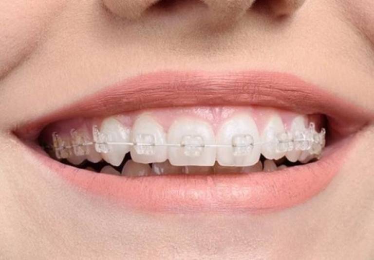 Mắc cài niềng răng sứ có màu sắc khá giống với màu răng