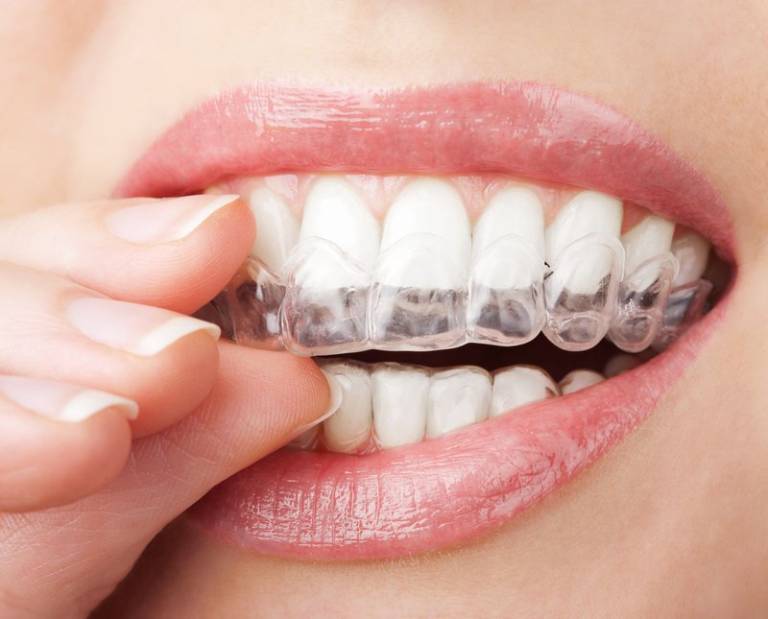 Mắc cài trong suốt là khay niềng răng được làm từ nhựa nha khoa cao cấp 