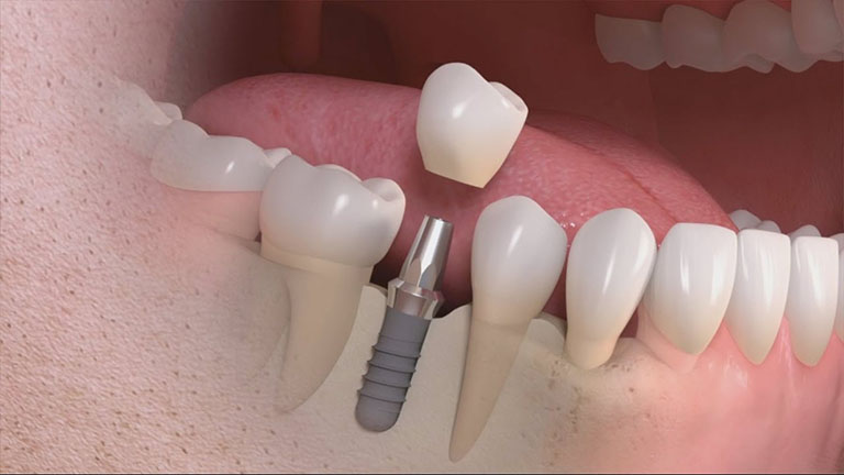trồng răng implant tại hải phòng