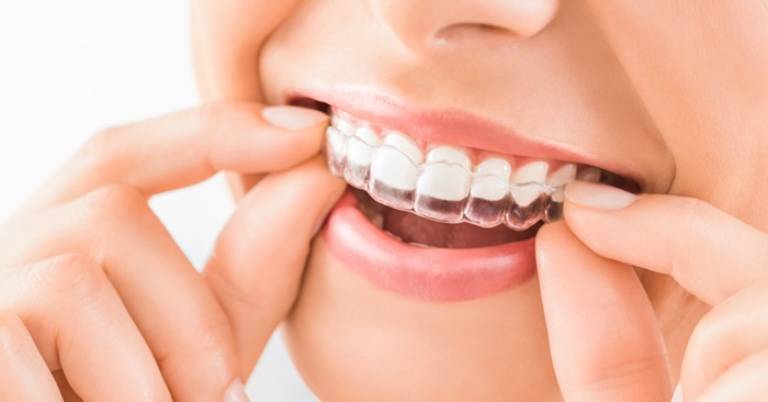 Niềng răng trong suốt không mắc cài là phương pháp niềng răng có tính thẩm mỹ cao