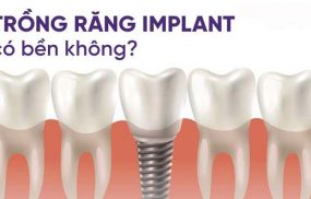 Răng implant có bền không? Sử dụng được bao lâu?