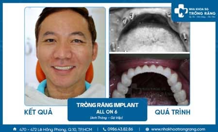 Nha khoa trồng răng SG 4