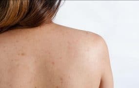Bệnh viêm nang lông ở lưng và các biện pháp điều trị