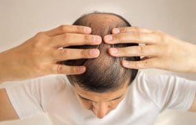 Nam giới bị rụng tóc phải điều trị như thế nào?