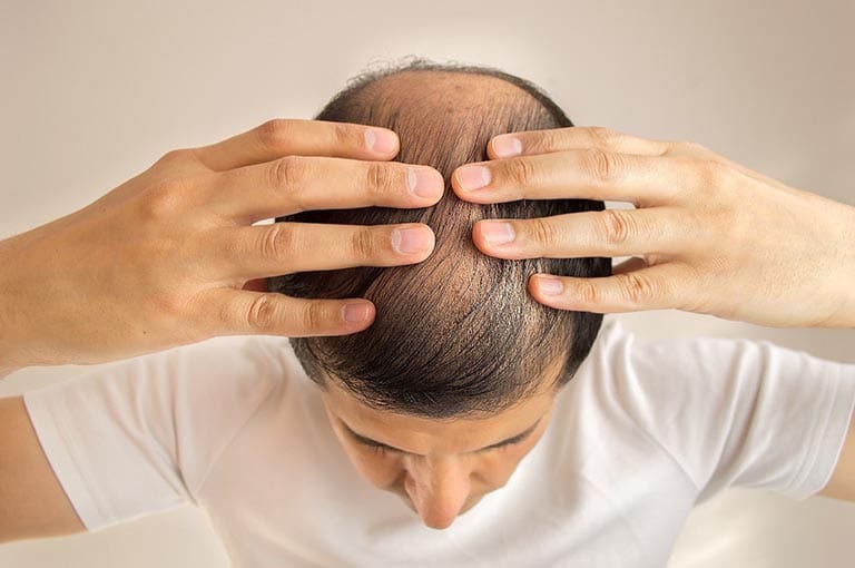 Nam giới bị rụng tóc phải điều trị như thế nào?