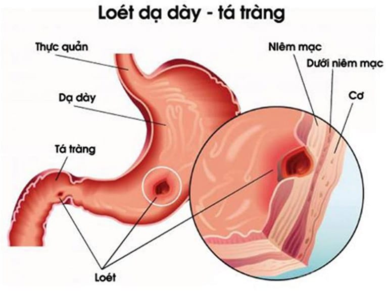 Viêm loét dạ dày có thể gây đau bụng âm ỉ nhiều ngày 