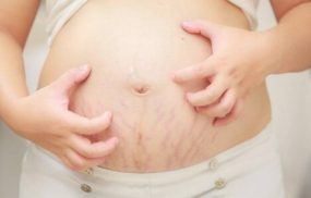 Có đến 70 - 80% các mẹ bầu gặp phải các vấn đề về da nhất là rạn da khi mang thai