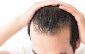 Rụng tóc 2 bên thái dương là tình trạng thường gặp, do nhiều nguyên nhân gây ra
