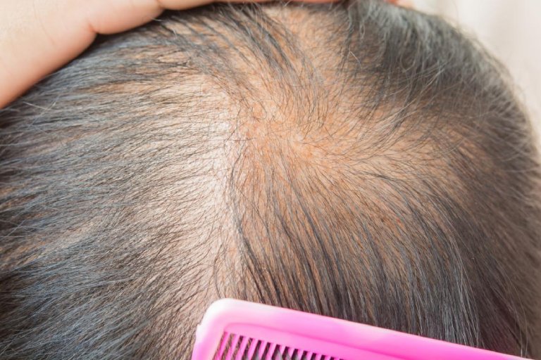 Rụng tóc androgen là gì? Nguyên nhân và cách chữa trị