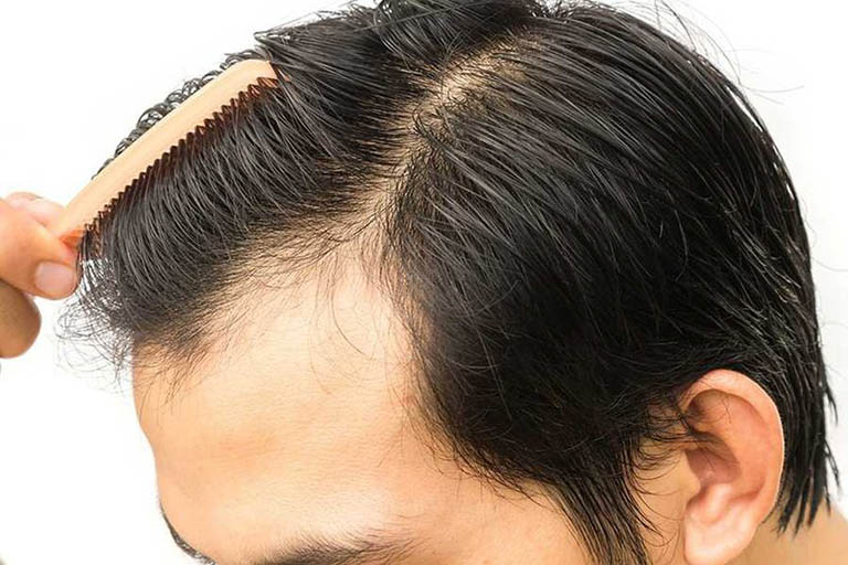 Rụng tóc hói đầu ở nam giới
