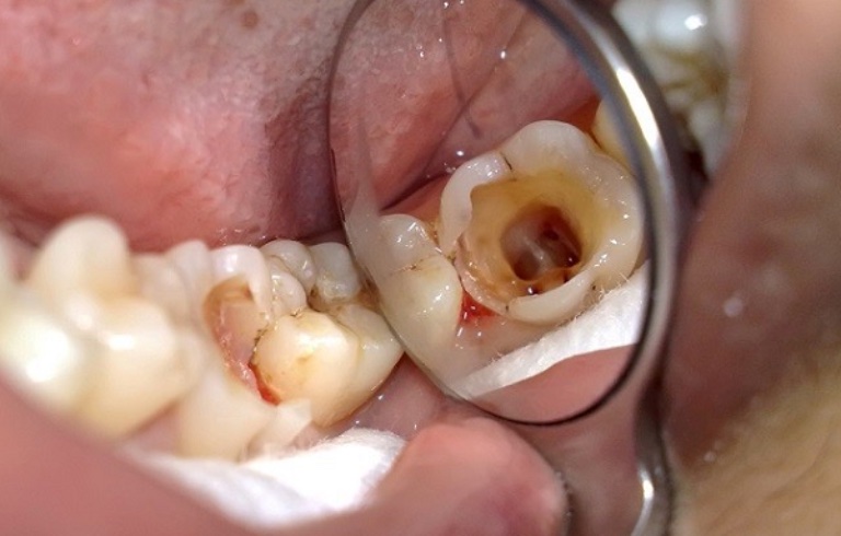  đau răng hàm trên bên trái 
