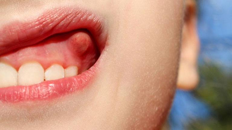 Bệnh viêm lợi do các vi khuẩn bám trên cao răng và các mảng bám trên răng gây ra 