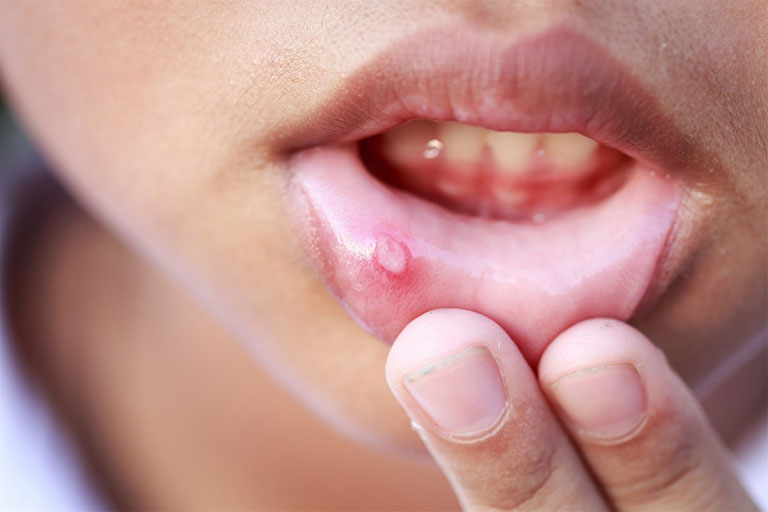 Nhiệt miệng là một trong các bệnh về răng miệng rất phổ biến 