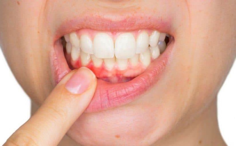 cách chữa viêm nha chu răng tại nhà