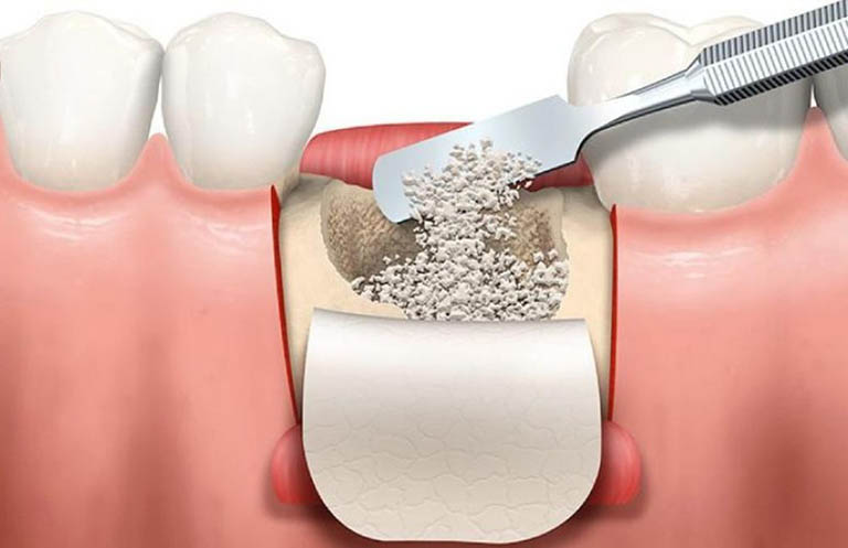 Để bảo tồn răng, ghép xương điều trị viêm nha chu nặng là phương pháp thường được chỉ định 