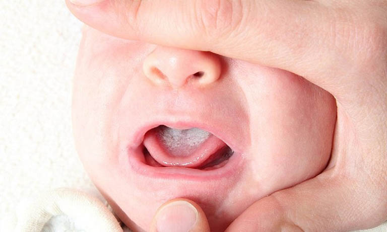 Các thông tin cần biết về bệnh nhiệt miệng ở trẻ sơ sinh dưới 1 tuổi