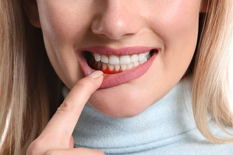 Viêm nướu răng là gì