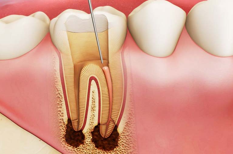 Rút tủy răng là phương pháp được chỉ định trong các trường hợp bị viêm tủy chưa gây biến chứng